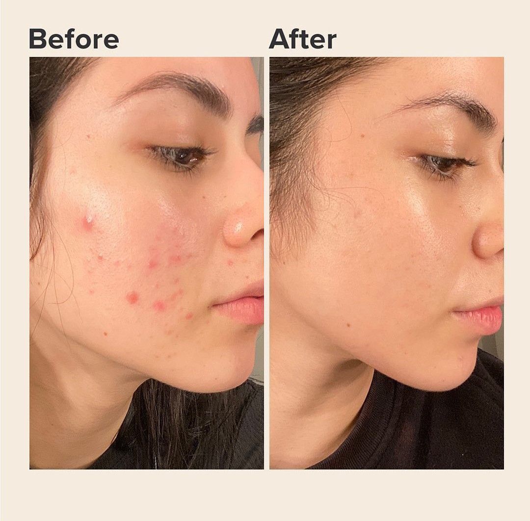 Pure Skin Anti Acne Light Print Cleanser Best Acne Treatment | BIOAQUA